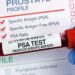 A Growing Crisis: One Diagnosis Every Eight Minutes – Macmillan Reports Record UK Prostate Cancer Rates