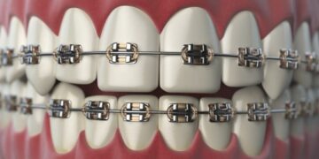 Braces Beyond Treatment: Gen Z’s Fashion Craze and the Hidden Dental Risks
