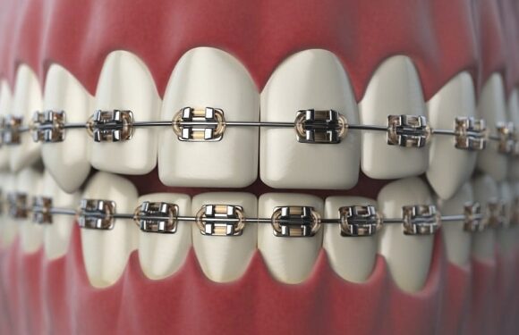 Braces Beyond Treatment: Gen Z’s Fashion Craze and the Hidden Dental Risks