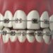 Braces Beyond Treatment: Gen Z’s Fashion Craze and the Hidden Dental Risks