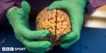 NFL: At Least One in Four Ex-Players Had Brain Disease, Says Study